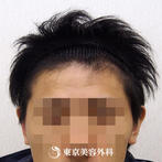 【オリジナル発毛薬・メソセラピー｜ar3277】男性発毛 年齢：26歳の症例