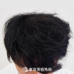 【オリジナル発毛薬・メソセラピー｜fy4926】男性発毛 年齢：30歳の症例