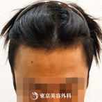 【オリジナル発毛薬・メソセラピー｜fy5568】男性発毛 年齢：40歳の症例