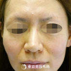 【鼻尖形成｜gz1946】鼻先を整えてすっきりと細い鼻先にの症例