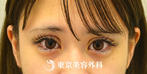 【挙筋短縮たるみ取り&ヒアルロン酸涙袋形成｜gz3336】眠たそうな目の印象を改善しパッチリとした目元にの症例
