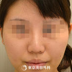 【鼻ドクターオーダーメイド｜gz3344】鼻先を細く整えモデルのようなシャープな鼻にの症例