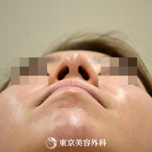 【鼻オーダーメイド｜gz3671】の症例写真 before【9枚目】