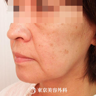 【フェイスリフト｜ok6785】の症例写真 before【3枚目】