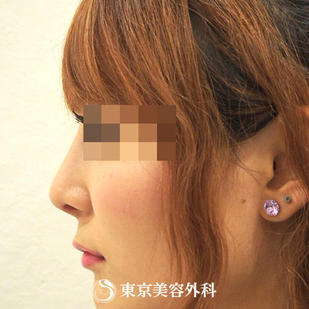 【鼻尖形成（耳介軟骨）&鼻プロテーゼ｜ou587】の症例写真 after【8枚目】