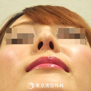 【鼻尖形成（耳介軟骨）&鼻プロテーゼ｜ou587】の症例写真 after【10枚目】