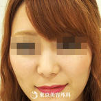 【鼻尖形成（耳介軟骨）&鼻プロテーゼ｜ou587】鼻を高く美しい鼻先にの症例