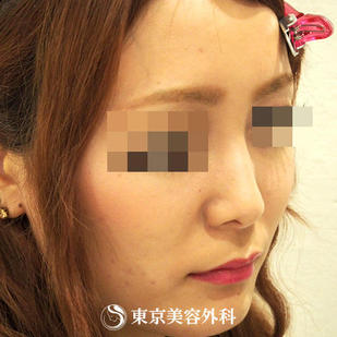 【鼻尖形成（耳介軟骨）&鼻プロテーゼ｜ou587】の症例写真 before【5枚目】