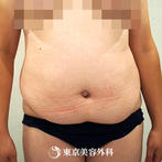 【脂肪吸引（腹部）｜ou819】脂肪吸引で思い通りのボディラインにの症例