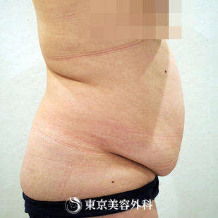 【脂肪吸引（腹部）｜ou819】の症例写真 before【5枚目】