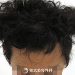 【オリジナル発毛薬・メソセラピー｜to1733】男性発毛 年齢：31歳の症例