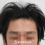 【オリジナル発毛薬・メソセラピー｜to2125】男性発毛 年齢：29歳の症例