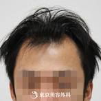 【オリジナル発毛薬・メソセラピー｜to2125】男性発毛 年齢：29歳の症例