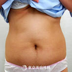 【脂肪吸引（腹部 ）｜ar2979】脂肪吸引で思い通りのボディラインにの症例