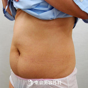 【脂肪吸引（腹部 ）｜ar2979】の症例写真 before【3枚目】