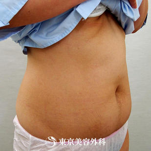 【脂肪吸引（腹部 ）｜ar2979】の症例写真 before【5枚目】