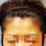【オリジナル発毛薬・メソセラピー｜fy2634】女性発毛 年齢：35歳の症例