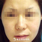 【鼻ヒアルロン酸｜fy3026】鼻筋を通しシャープなお顔の印象にの症例