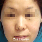 【鼻ヒアルロン酸｜fy3026】鼻筋を通しシャープなお顔の印象にの症例