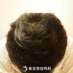 【オリジナル発毛薬・メソセラピー｜fy3418】男性発毛 年齢：23歳の症例