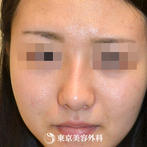 【隆鼻術｜gz147】鼻筋を整えて立体的な顔立ちへの症例