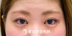 【ヒアルロン酸涙袋形成｜gz3375】涙袋施術で女性的な優しい潤いある目元にの症例