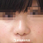 【小鼻縮小｜me3063】広がった鼻を整え女性らしい顔立ちへの症例