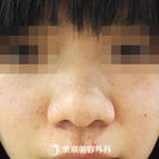 【小鼻縮小｜me3063】の症例