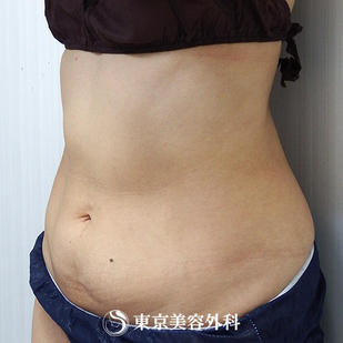 【脂肪吸引（上下腹部）｜ok7044】の症例写真 before【3枚目】