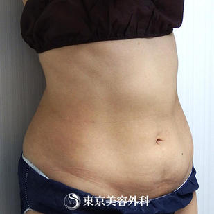【脂肪吸引（上下腹部）｜ok7044】の症例写真 before【5枚目】