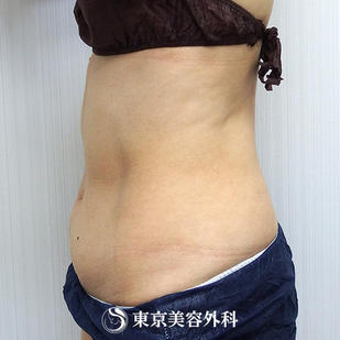 【脂肪吸引（上下腹部）｜ok7044】の症例写真 before【7枚目】