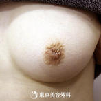 【陥没乳頭（左胸のみ）｜si581】陥没している乳首を自然な形にの症例