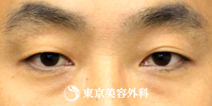 【眼瞼下垂】の症例写真 before【3枚目】
