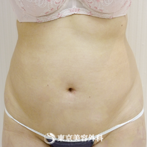 【脂肪吸引（腹部）｜g3944】脂肪吸引でスッキリしたウエストラインにの症例