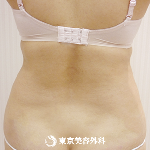 【脂肪吸引（腹部）｜g3944】の症例写真 before【7枚目】