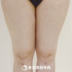 【脂肪吸引（大腿部）｜g3944】の症例