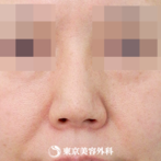 【小鼻縮小(ケーブル法)｜ow7770】メスを使わず女性らしい自然な小鼻にの症例