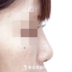 【鼻プロテーゼ｜ok3606】低く丸い鼻に高さを出し、洗練された印象にの症例