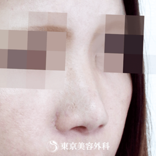 【鼻プロテーゼ｜ok3606】の症例写真 before【3枚目】