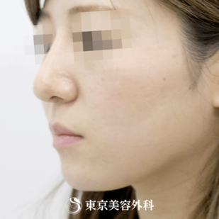 【鼻ヒアルロン酸・顎ヒアルロン酸｜si1242】の症例写真 after【4枚目】