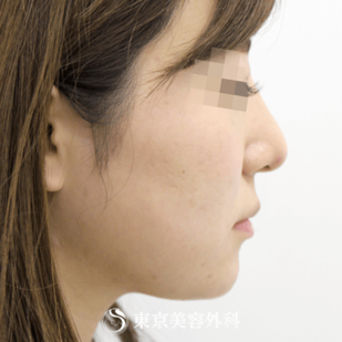【鼻ヒアルロン酸・顎ヒアルロン酸｜si1242】の症例写真 after【2枚目】