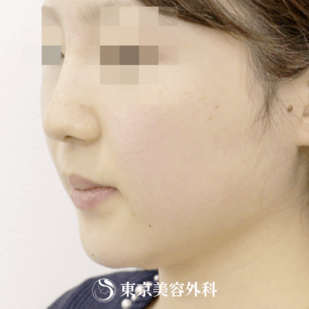 【鼻ヒアルロン酸・顎ヒアルロン酸｜si1242】の症例写真 before【3枚目】