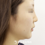 【鼻ヒアルロン酸・顎ヒアルロン酸｜si1242】たった5分でバランスのとれた綺麗な横顔にの症例