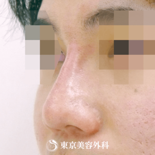 【鼻ヒアルロン酸｜gi5262】の症例写真 after【4枚目】