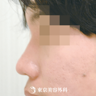 【鼻ヒアルロン酸｜gi5262】の症例写真 before【1枚目】