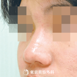 【鼻ヒアルロン酸｜gi5262】の症例写真 before【3枚目】