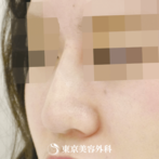 【鼻ヒアルロン酸｜gi5265】気軽に理想の鼻筋にの症例