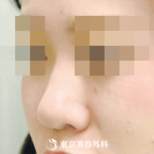 【鼻ヒアルロン酸｜gi5265】の症例写真 before【1枚目】