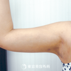【脂肪吸引（二の腕）｜ok6561】薄着で気になる二の腕の脂肪にの症例
