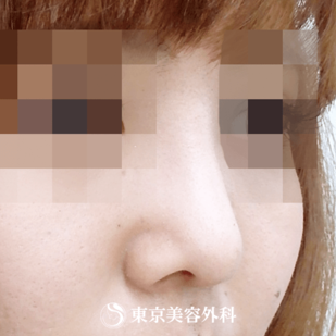 【鼻中隔延長（耳介軟骨）・オーダープロテーゼ｜ok6561】の症例写真 after【4枚目】